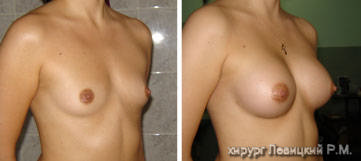 Mammary surgery - before and after operation