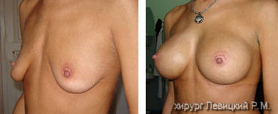 breast lift reduction ::::breast lift prices ::::exercise to lift breast :::: 