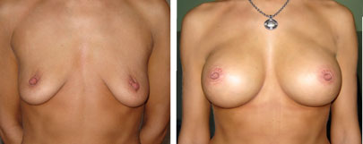 Mammary surgery - before and after operation