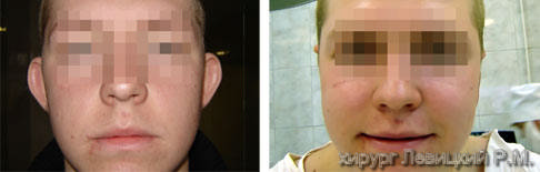 Ear surgery before and after operation