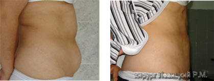 iposuction --  before and after operation ///liposuction cost ////  