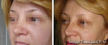 Nasal Surgery - before and after operation