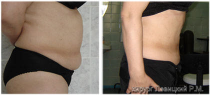  Lliposaction- before and after operation////  liposaction financing //// male liposaction  /// liposaction video ///liposaction photo male /// liposaction bellevue 
