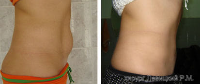 Tummy tuck, Abdominoplasty- before and after operation////  