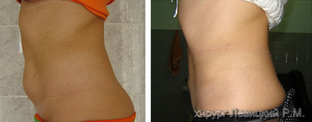Tummy tuck, Abdominoplasty- before and after operation//// 