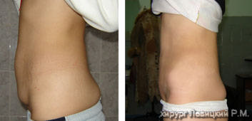 Tummy tuck, Abdominoplasty- before and after operation//// 