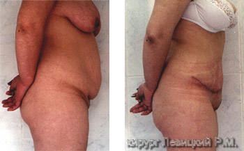 Tummy tuck, Abdominoplasty - before and after operation