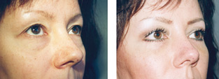 Belpharoplasty  - before and after operation