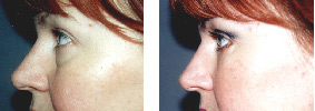 Belpharoplasty  - before and after operation