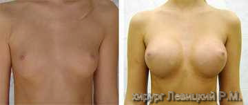 Mammary surgery - before and after operation 
