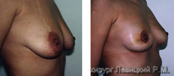  Mammary surgery - before and after operation  