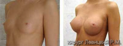 Mammary surgery - before and after operation 