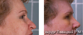 Nasal Surgery - before and after operation