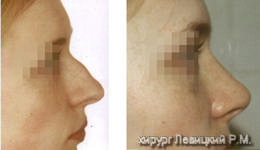 Nasal Surgery - before and after operation