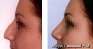 Nasal Surgery - before and after operation