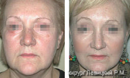 Rejuvenation Surgery - before and after operation 