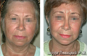 Rejuvenation Surgery  of the face - before and after operation 