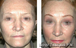 Facelift - before and after operation